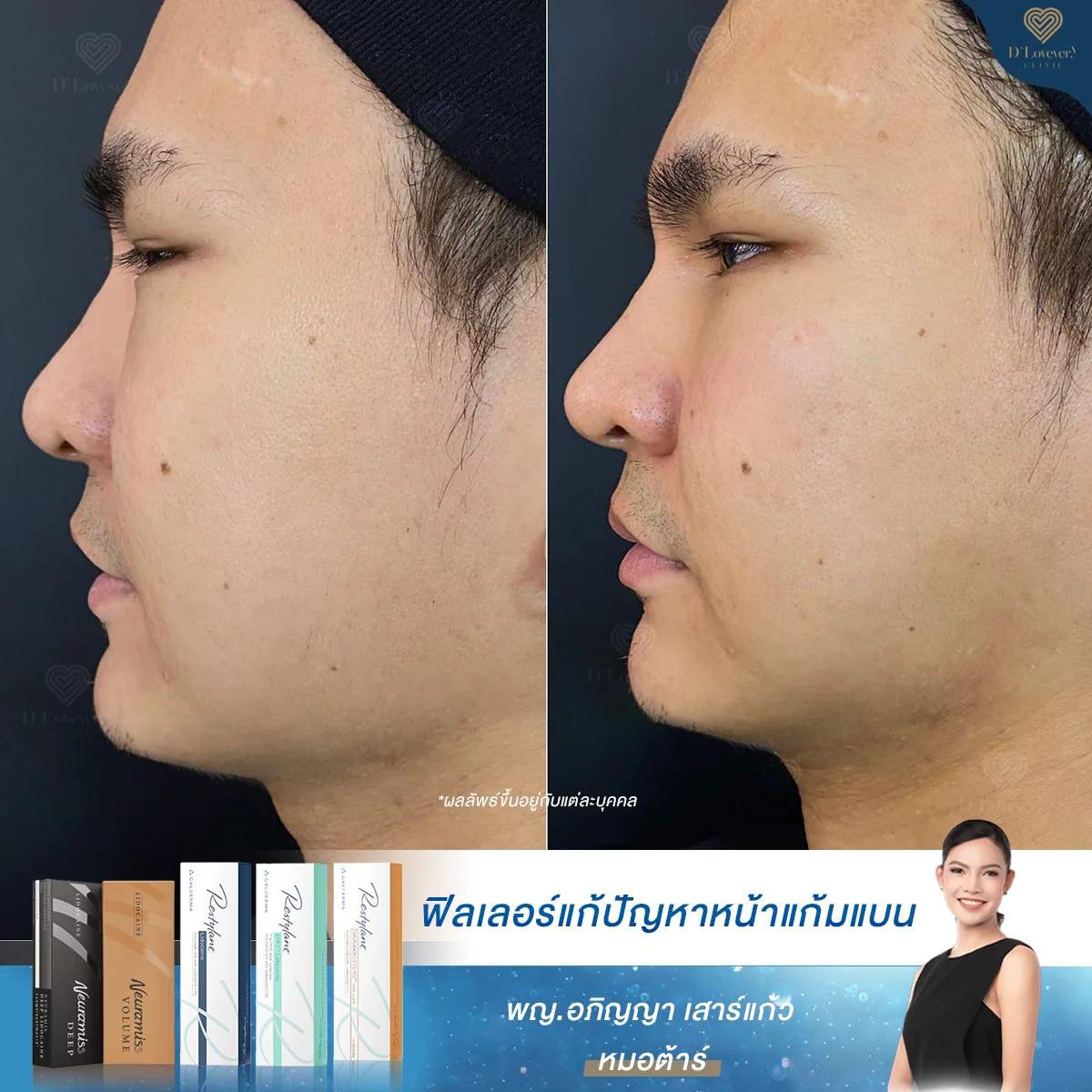 ฟิลเลอร์หน้าแก้ม [รีวิวเคสผู้ชาย] ต้องการปรับมิติของใบหน้าให้โดดเด่นมากขึ้น ทั้งหน้าตรงและด้านข้าง