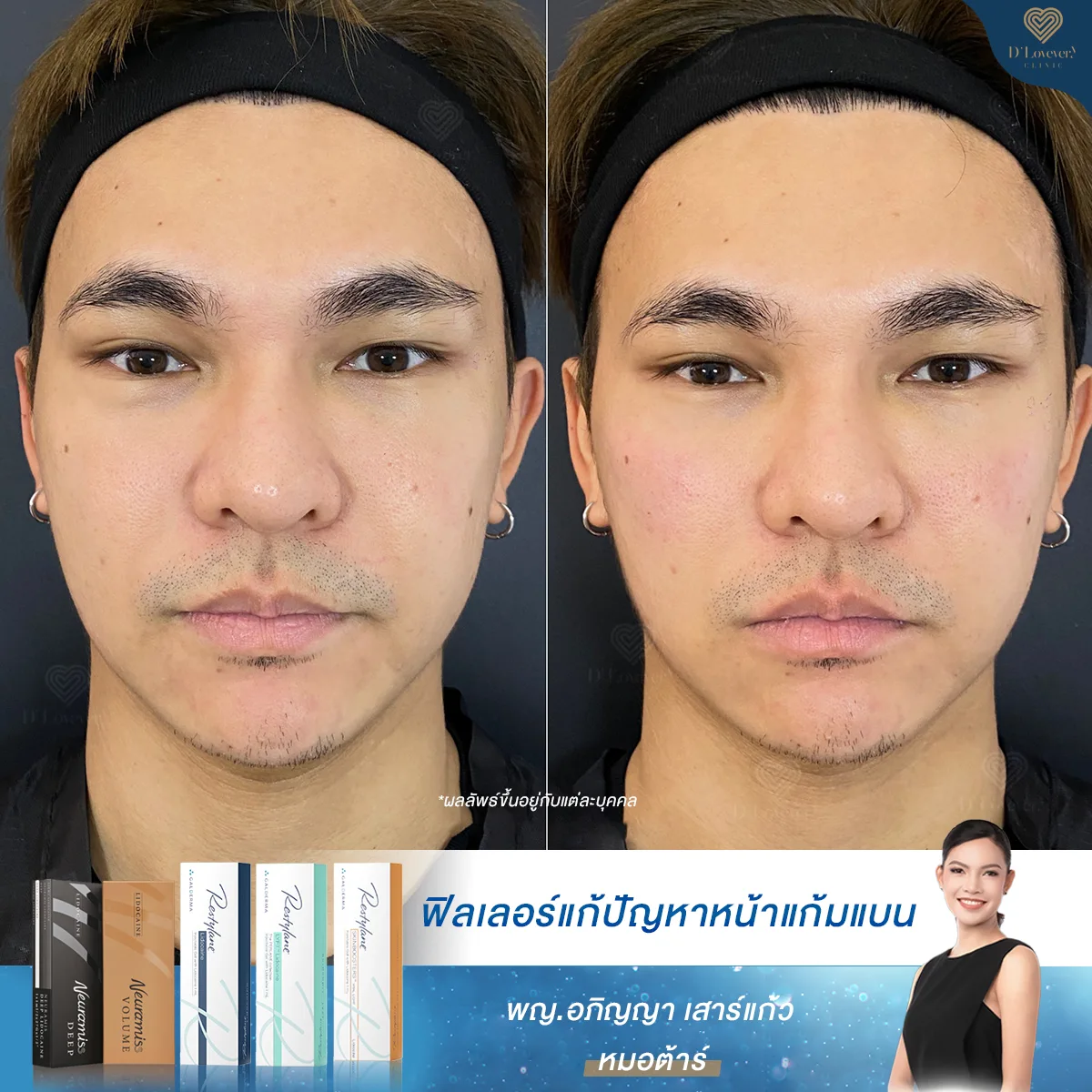 Mr Tan Filler Cheeks Before After