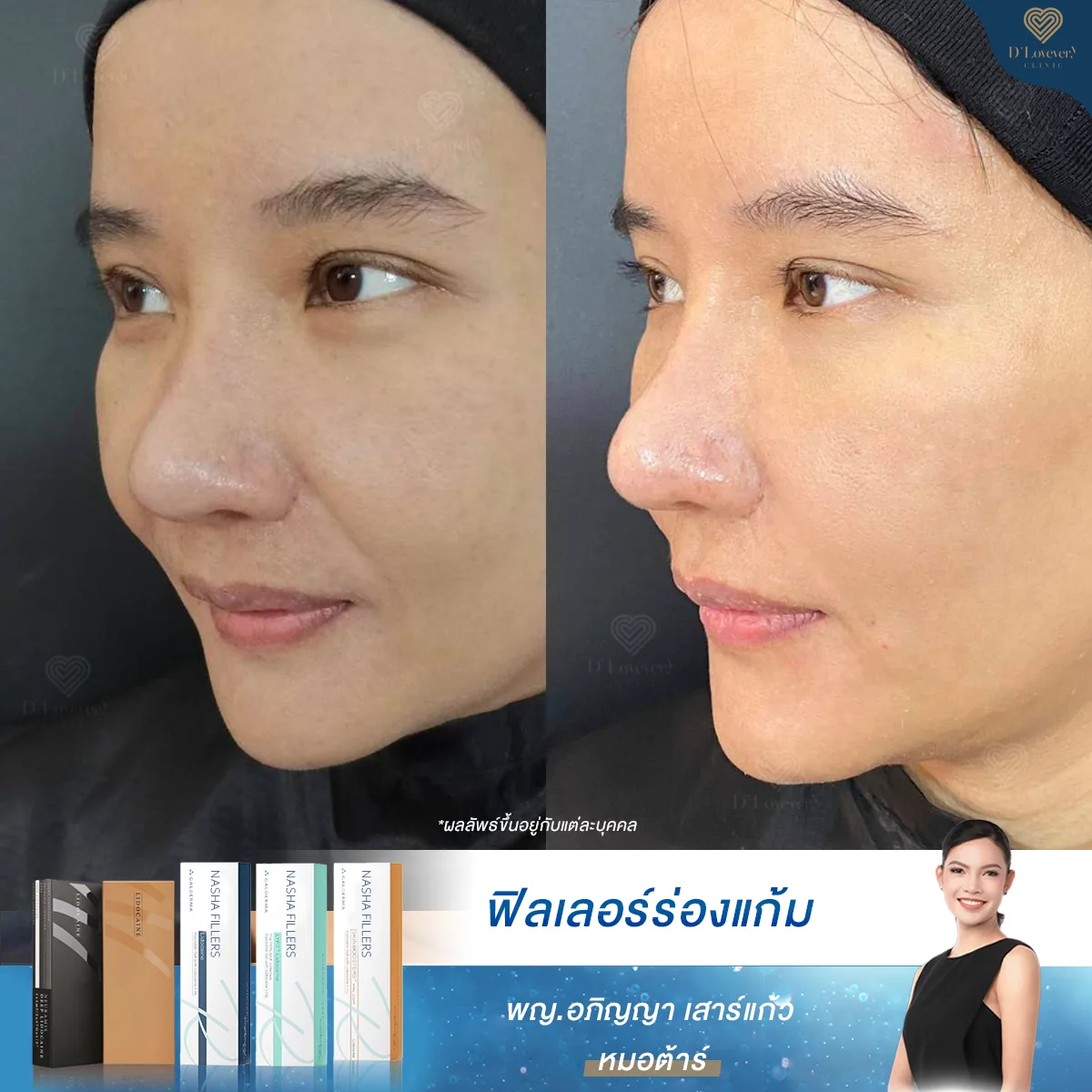 Before and after nasolabial fold filler: fuller cheeks, softened smile lines.
