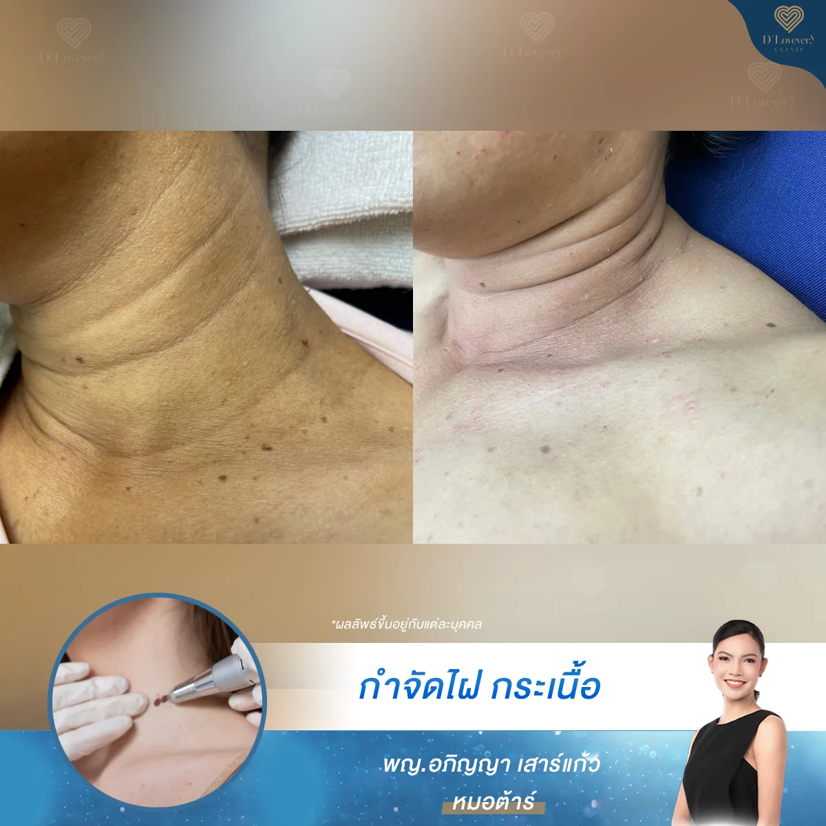 Neck mole removal before-and-after: reduced brown spots and smoother skin