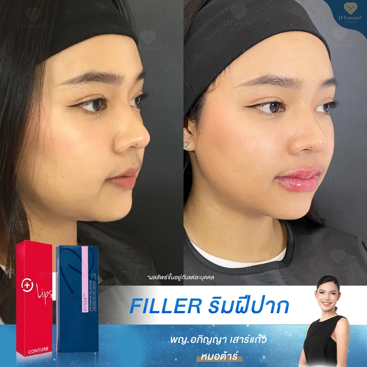 Restylane Filler Before After 2 3
