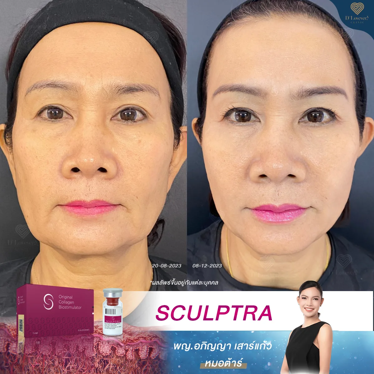 [รีวิว Sculptra] เคสอายุ 50+ เหมาะไหม ทำแล้วหน้าตึงกระชับขึ้นระดับไหน มาดูเคสนี้กันค่ะทุกคน