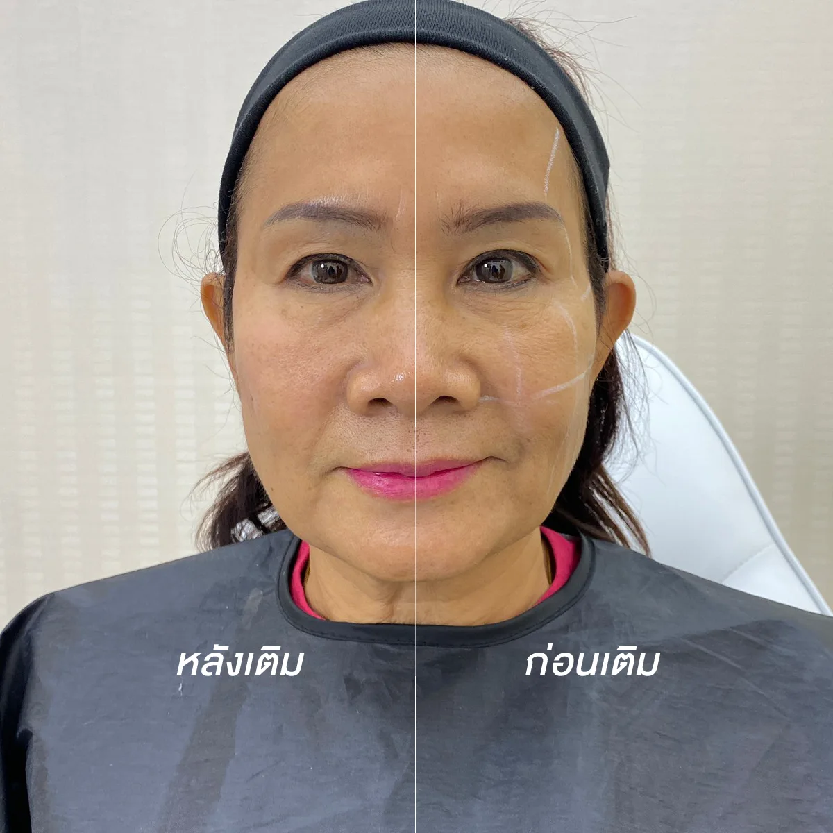 sculptra รีวิว