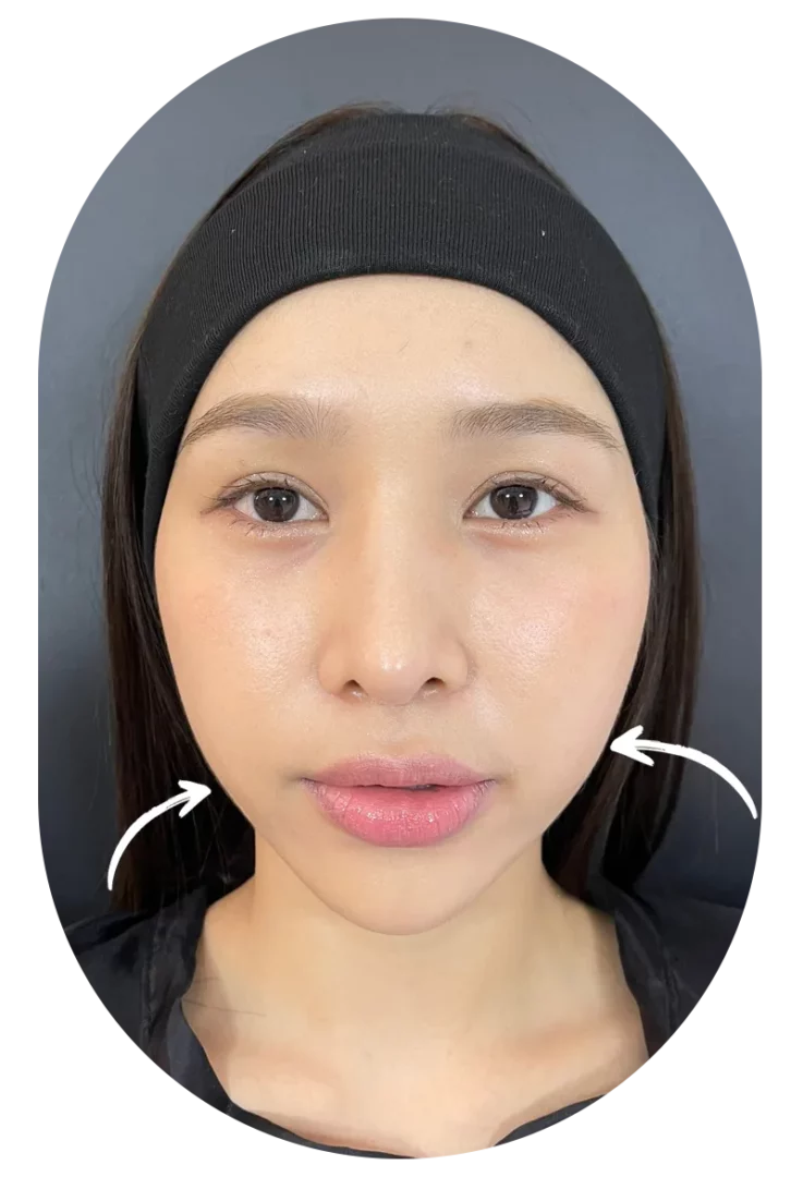 Sculptra Review Before Arrow 1