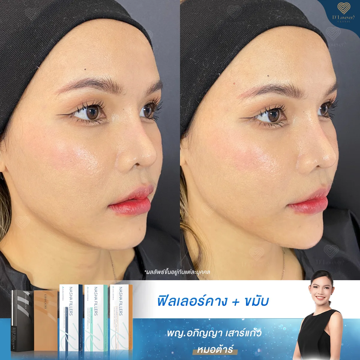 รีวิวฟิลเลอร์คาง