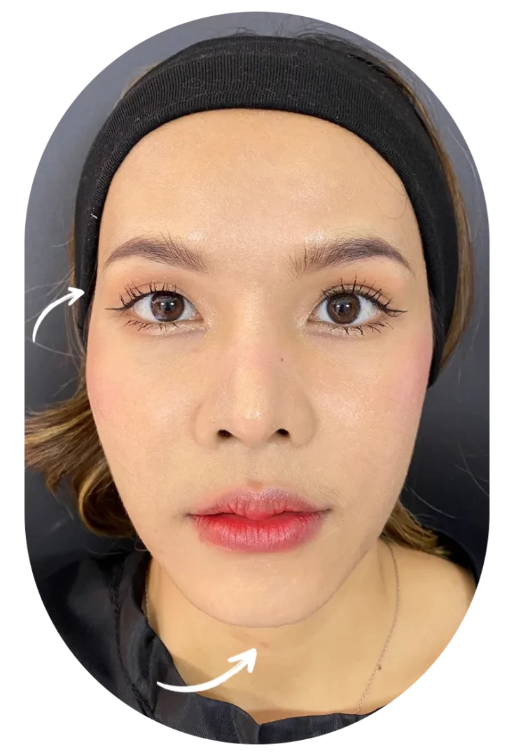 Short Chin Filler Before K Sasi