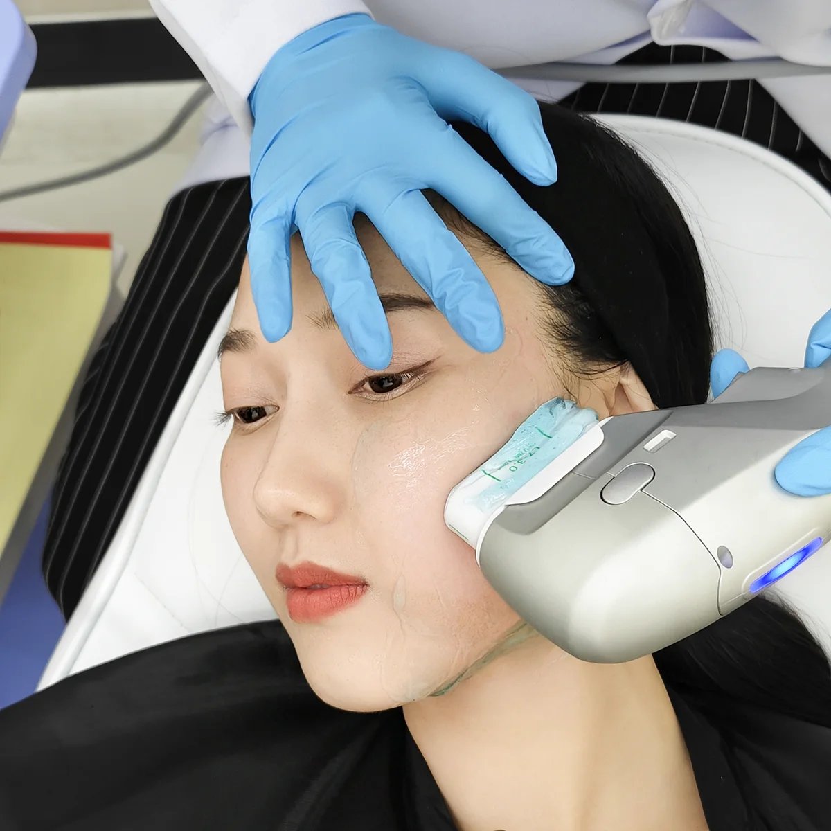 Teen Hifu Cheek Treatment