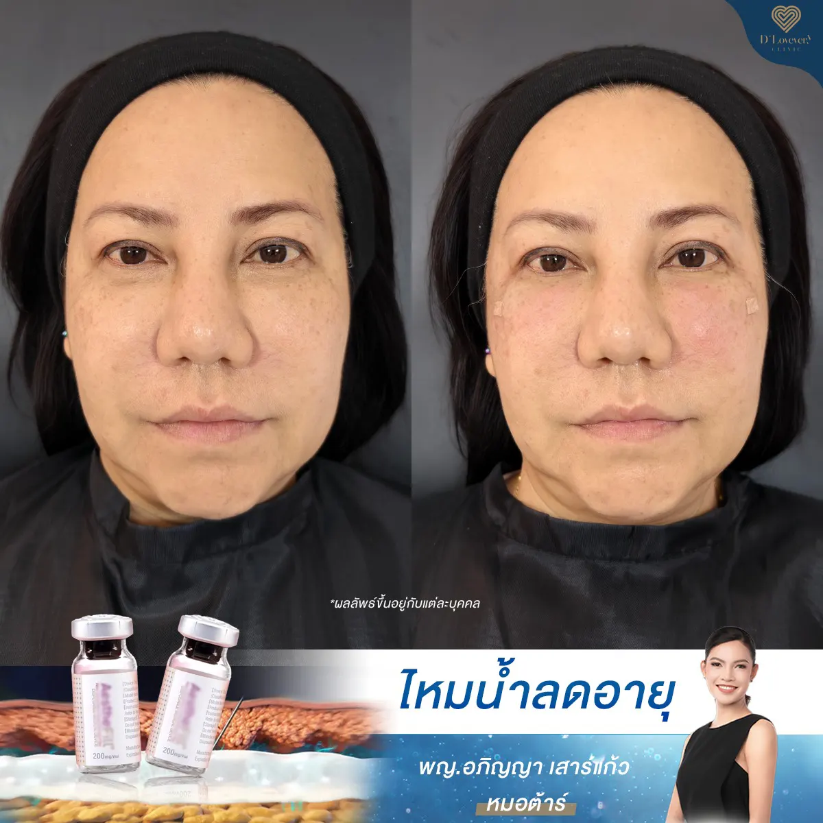AestheFill under-eye filler before and after, reduced tear troughs and fuller midface