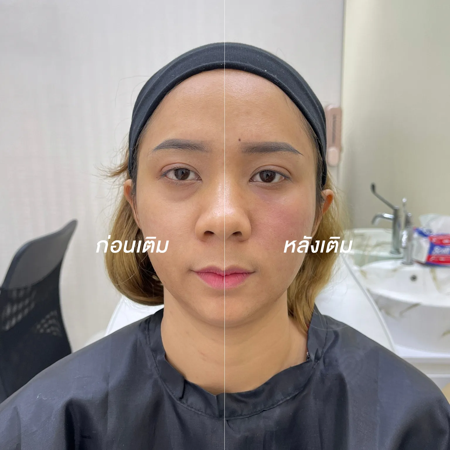 รีวิวฟิลเลอร์ใต้ตา เทียบ ข้างต่อข้าง