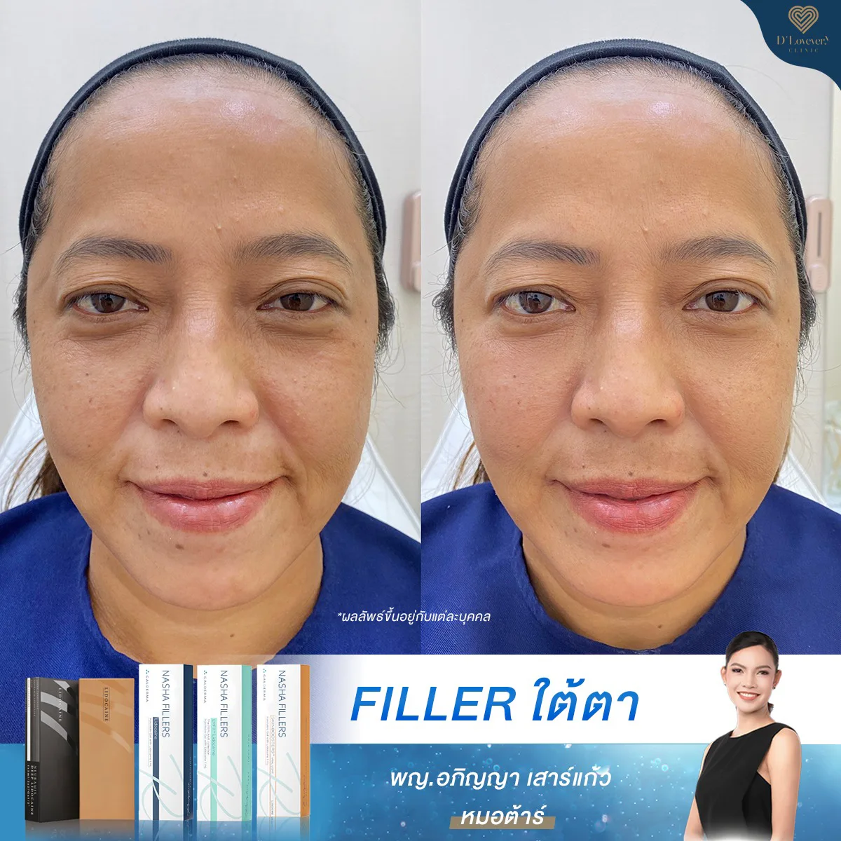 ฟิลเลอร์ใต้ตา รีวิว