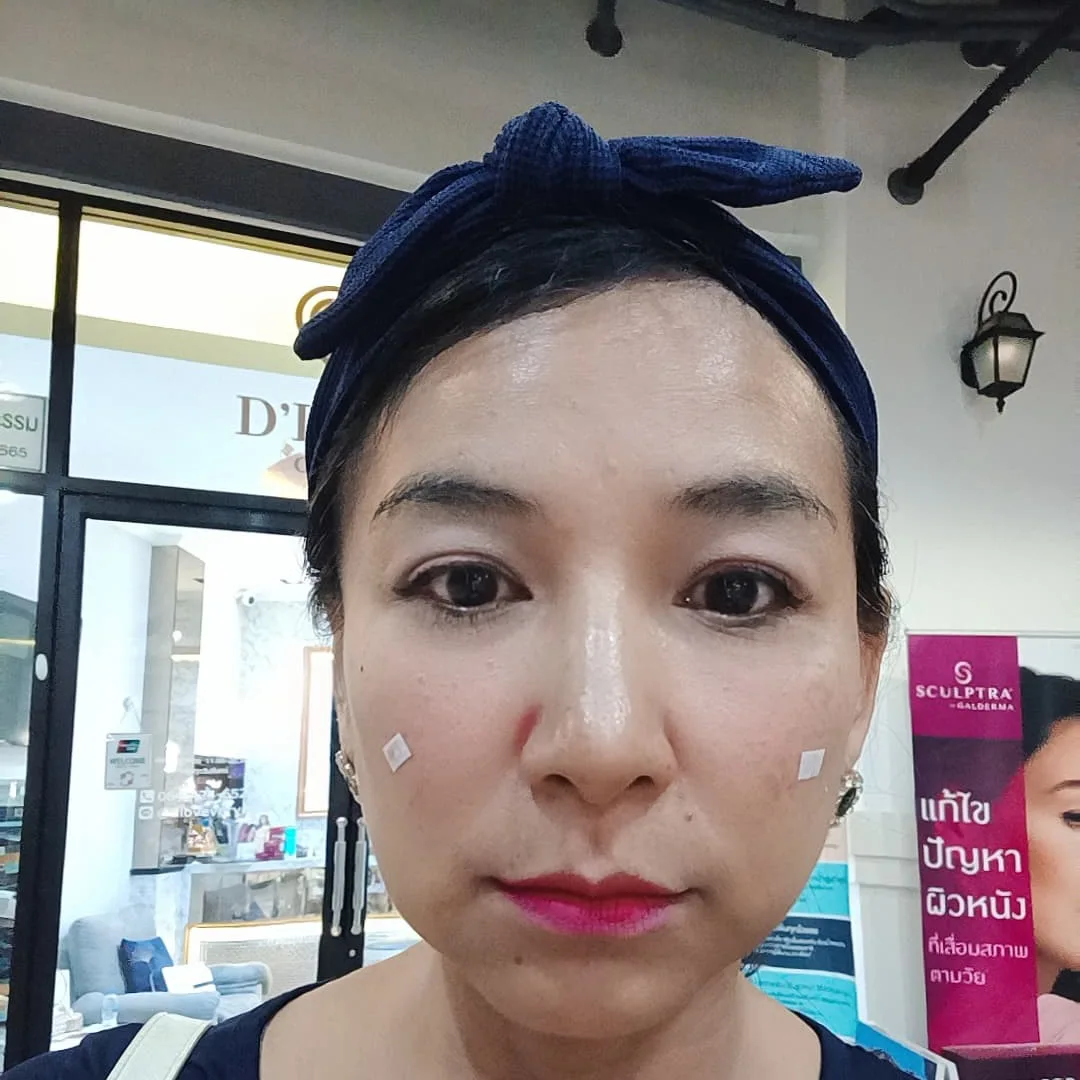 รีวิวฟิลเลอร์ใต้ตา