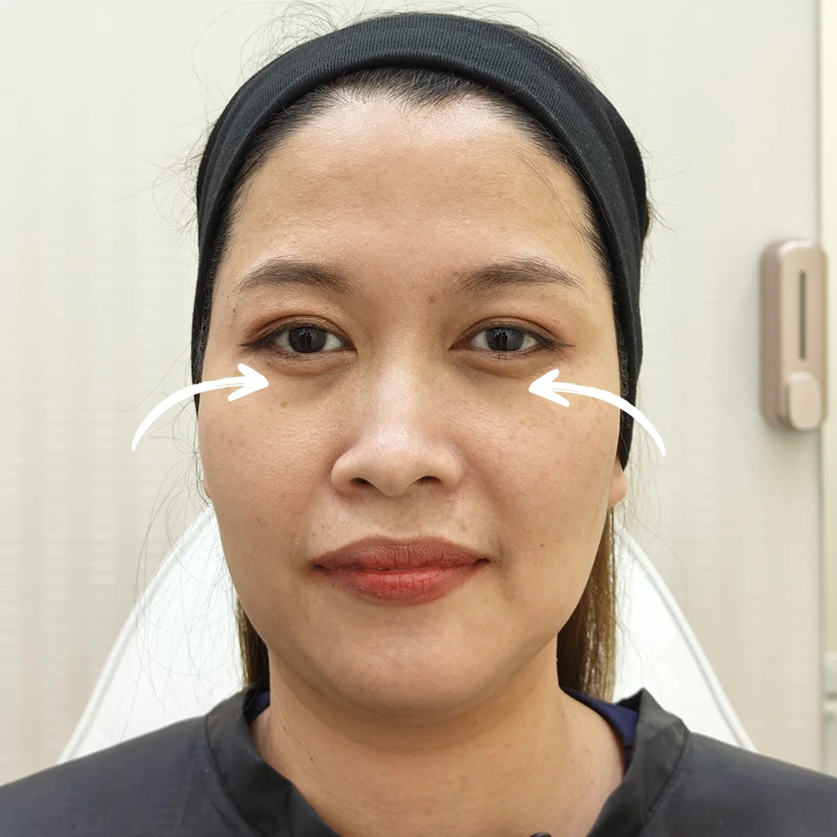 ไหมน้ำ ฉีดตรงไหนได้บ้าง