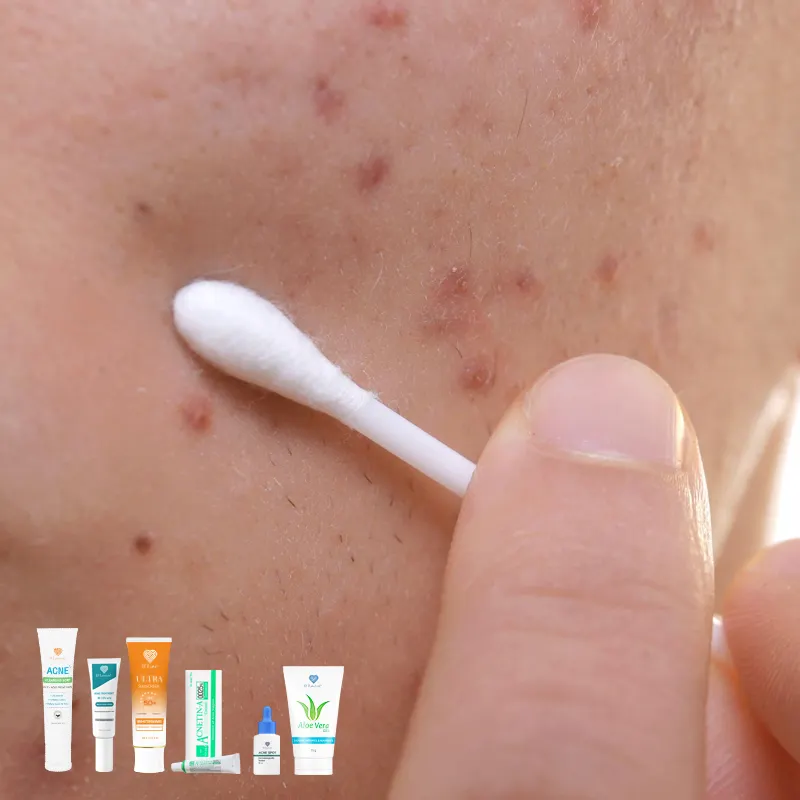 Close-up jawline acne spot treatment with cotton swab applying product