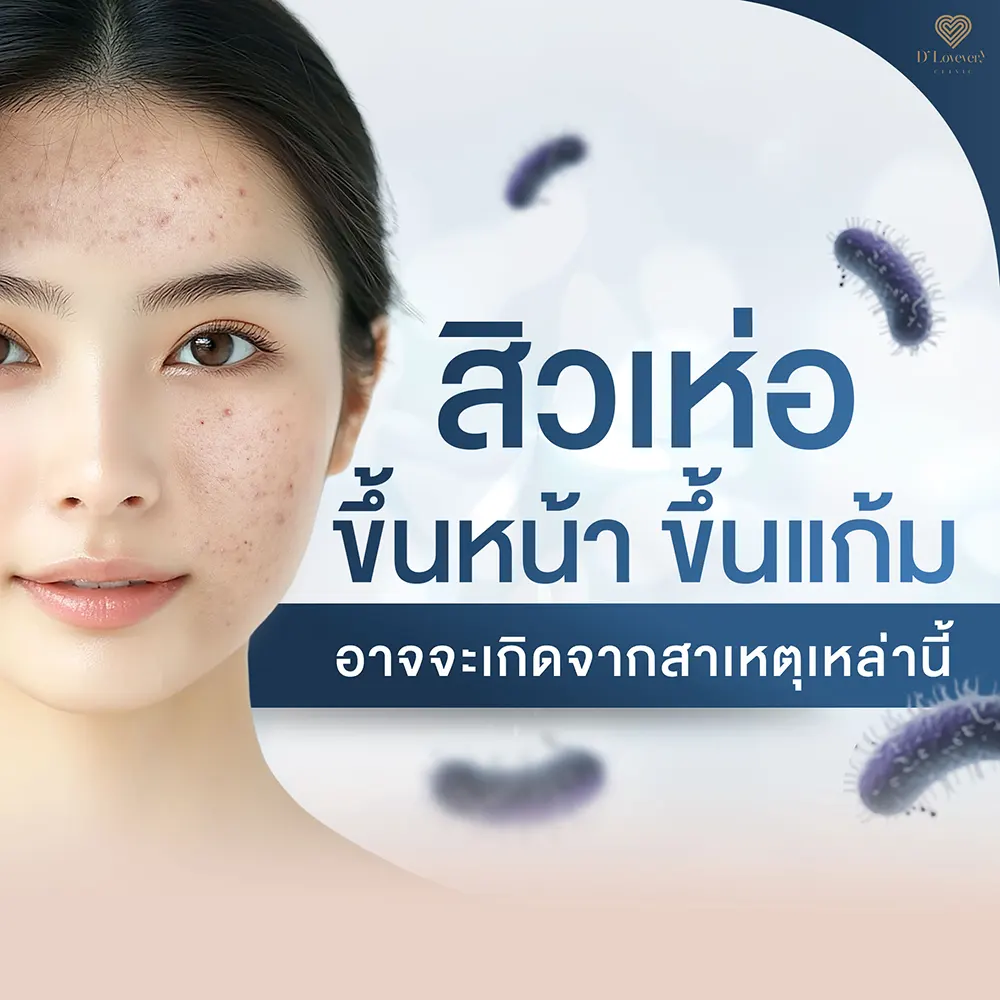 สิวเห่อ ขึ้นหน้า ขึ้นแก้ม อาจจะเกิดจากสาเหตุเหล่านี้