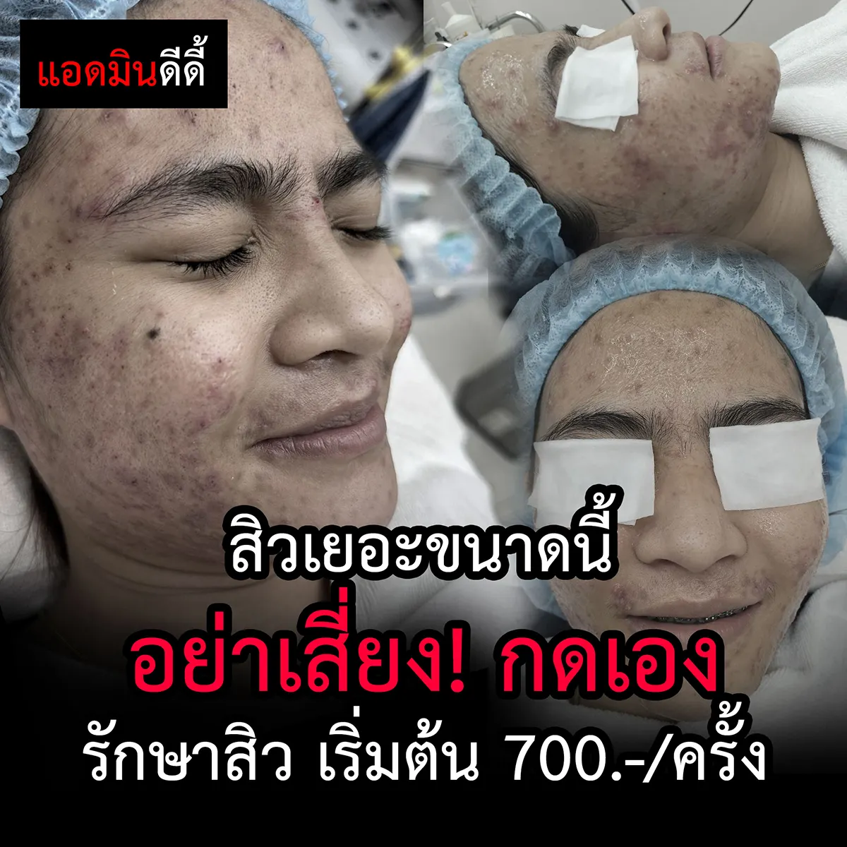 กดสิวเอง