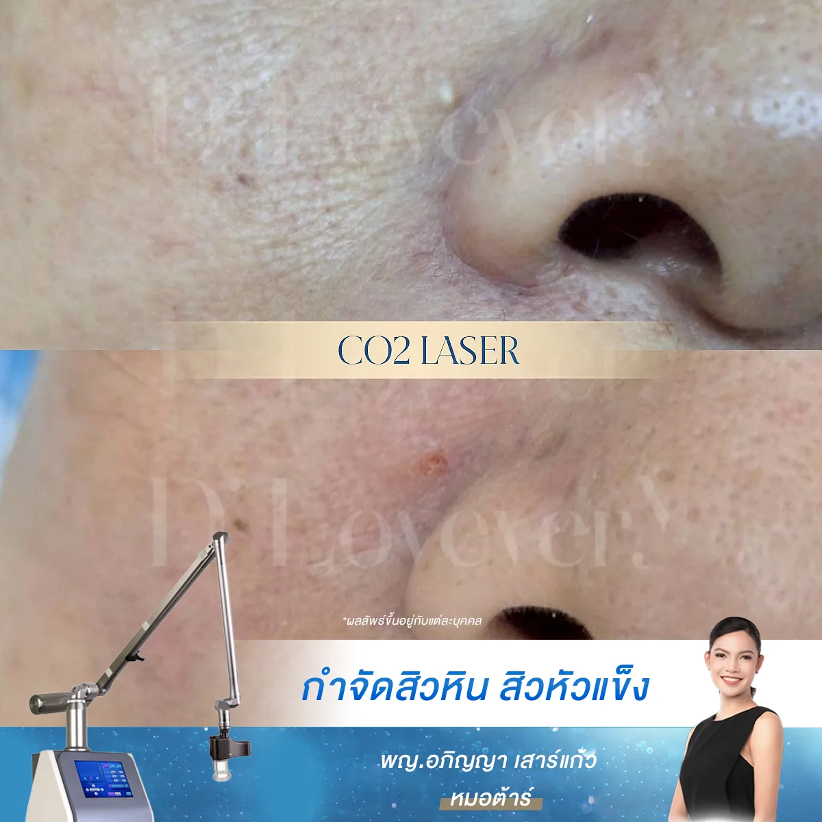 กำจัดสิวหิน ราคาเริ่มต้น 500 บาท