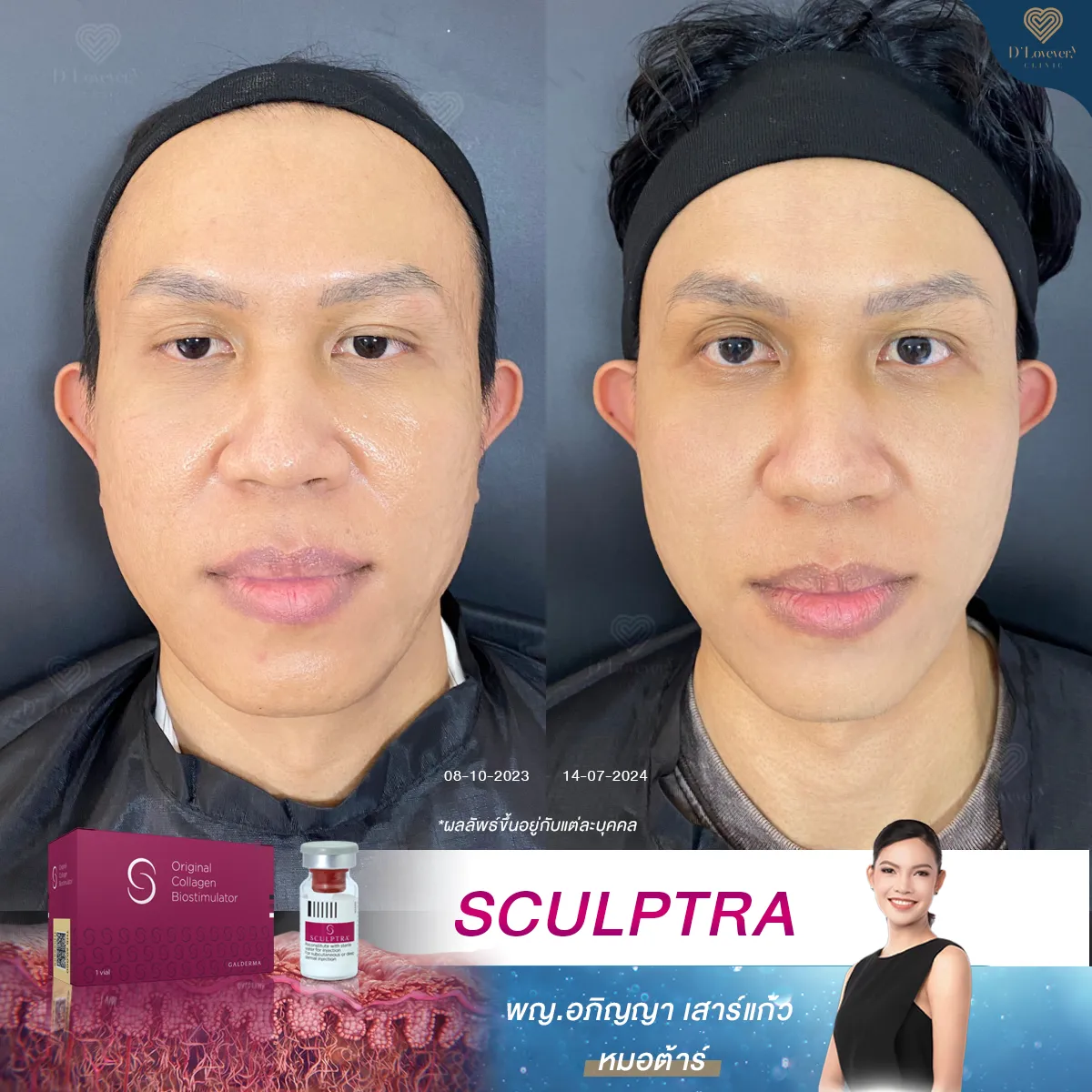 [รีวิว Sculptra] ผิวเฟิร์มกระชับขึ้นเยอะ ผ่านมา 8 เดือนแล้ว ลูกค้าบอกคุ้ม ทำเถอะ!