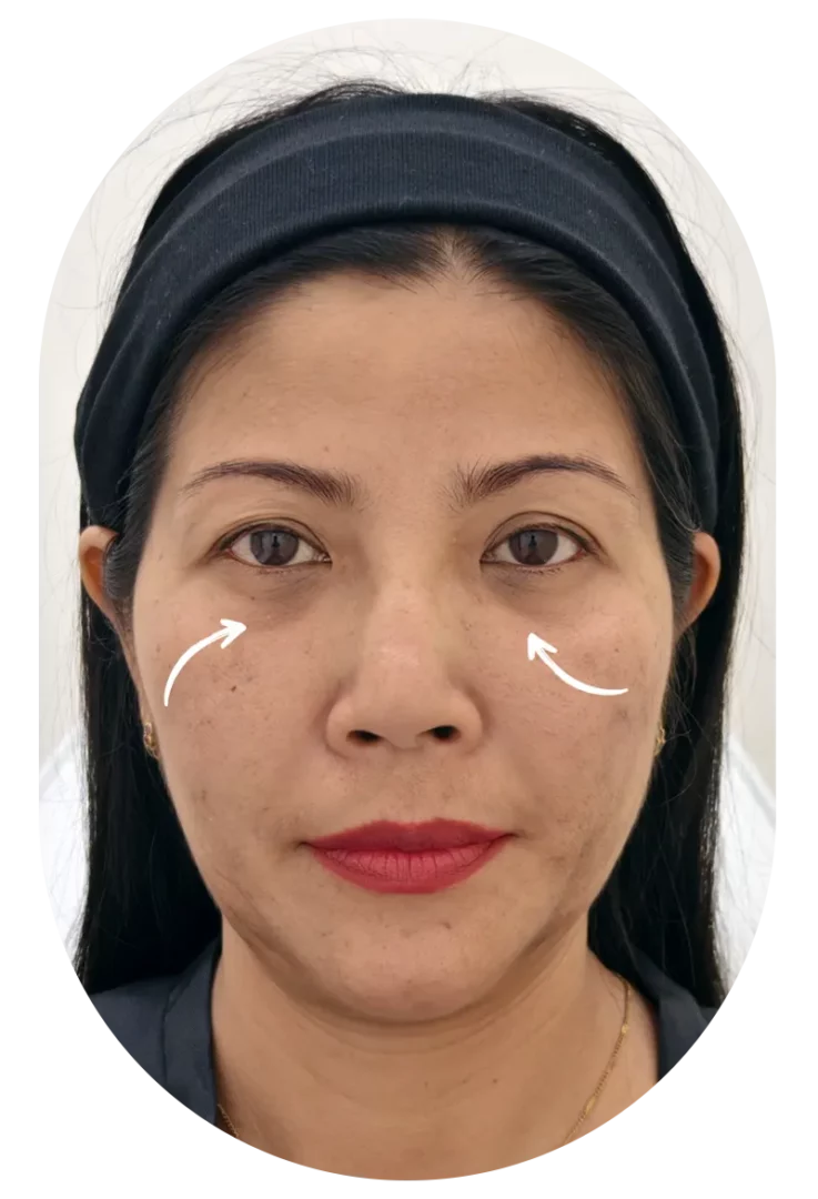 Dark Circles Filler Before Case 85