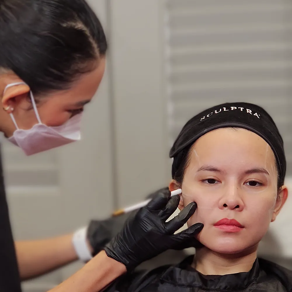Sculptra non-surgical cheek injection in aesthetic clinic
