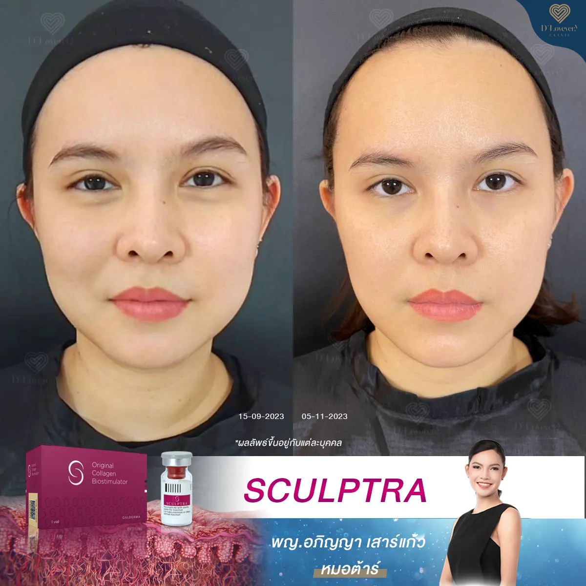 ฉีด Sculptra 2 จุดนี้ [เพื่อยกกรอบหน้า] เพื่อผิวหน้าตึงกระชับ ผิวดีอยู่แล้ว แต่อยากได้แบบ X2
