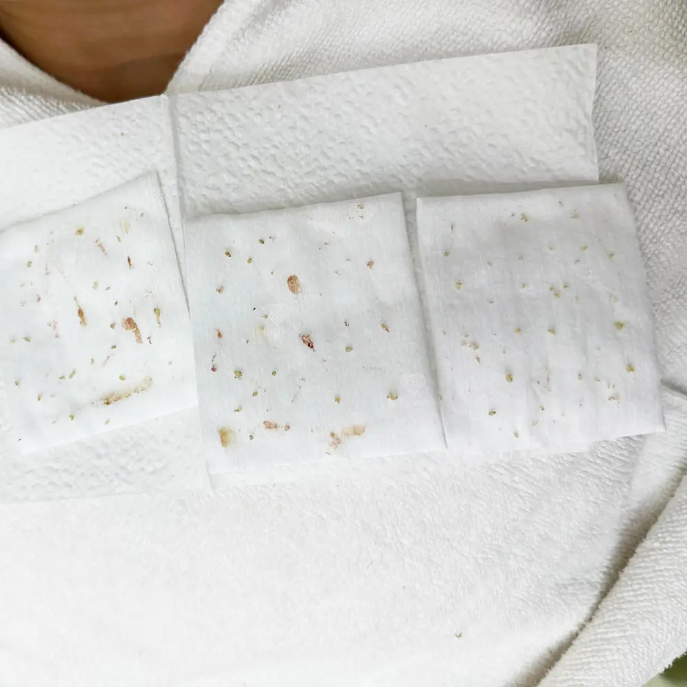 Acne extraction cotton pads showing yellow-green and brown debris