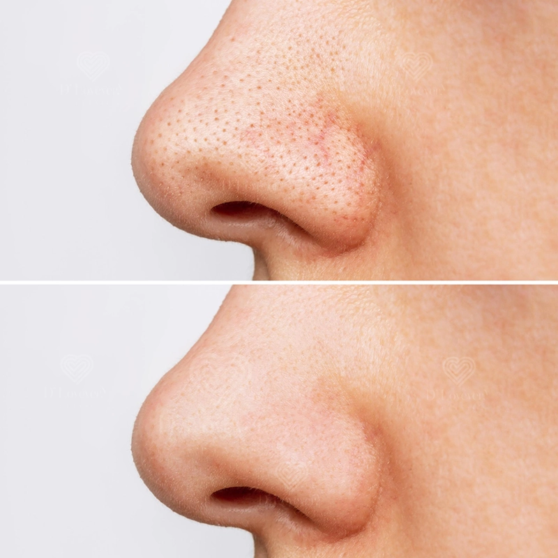 Blackhead removal nose before and after — smoother skin, reduced pores