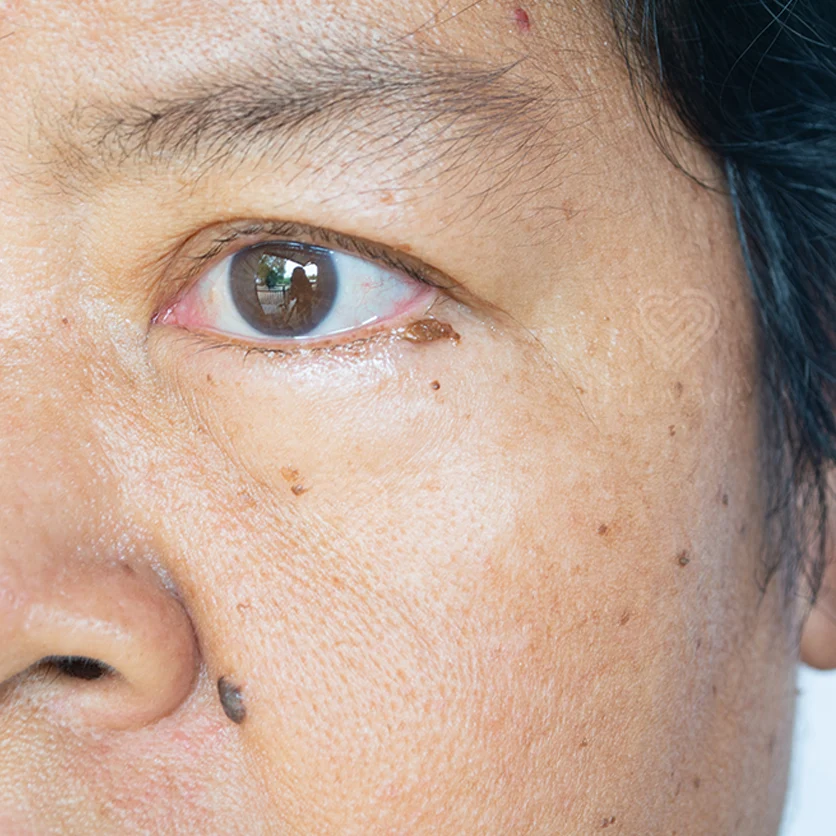 Close-up of left eye and cheek mole on warm brown skin