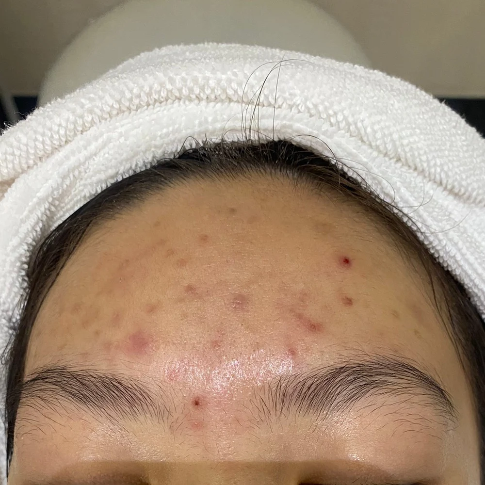 Close-up of forehead acne: oily skin with red papules and dark healing spots