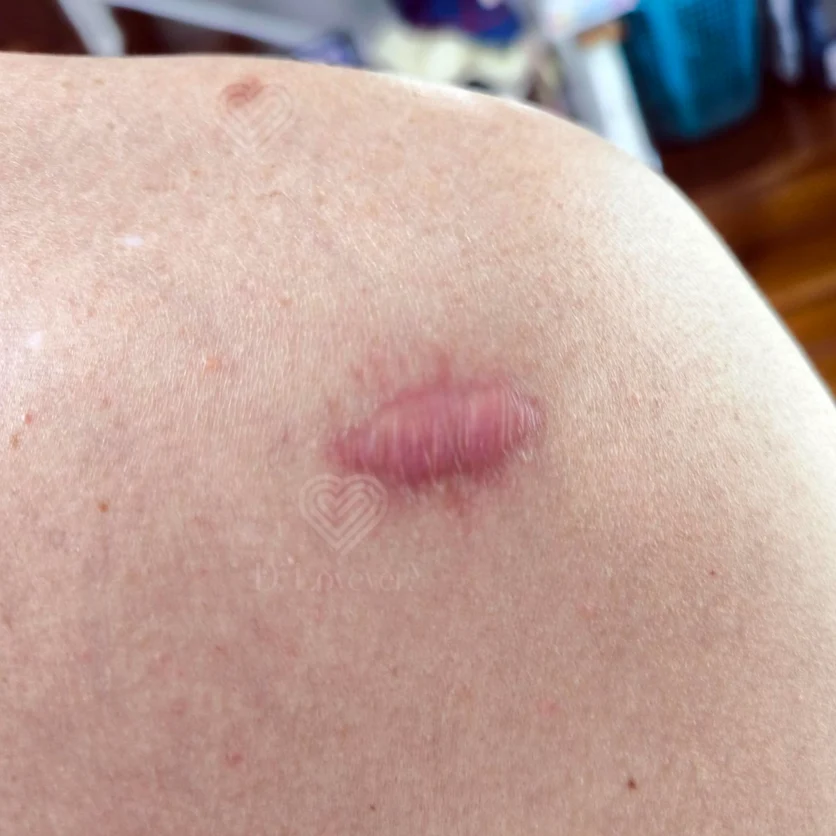 Close-up of upper arm keloid scar after injection treatment