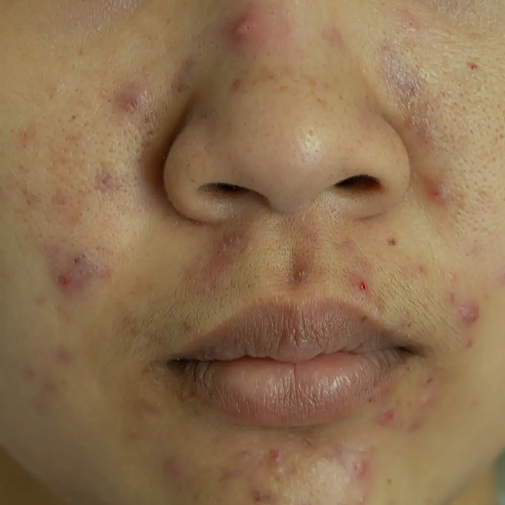 Close-up of lower face with steroid acne pustules, scabs, and healing dark spots