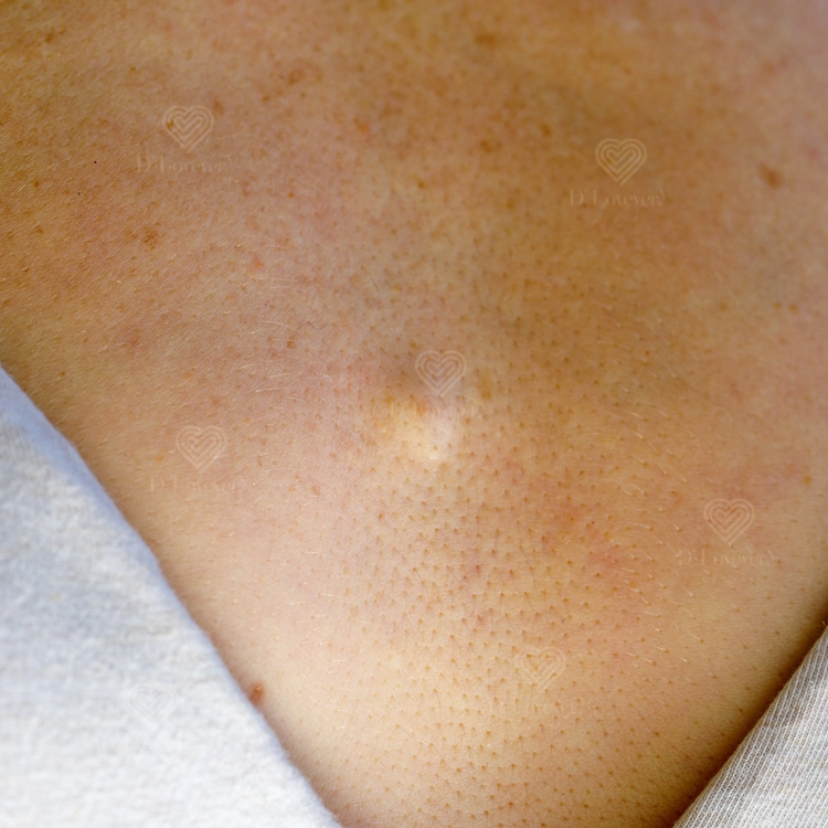 Close-up whitehead acne blemish on light-to-medium skin