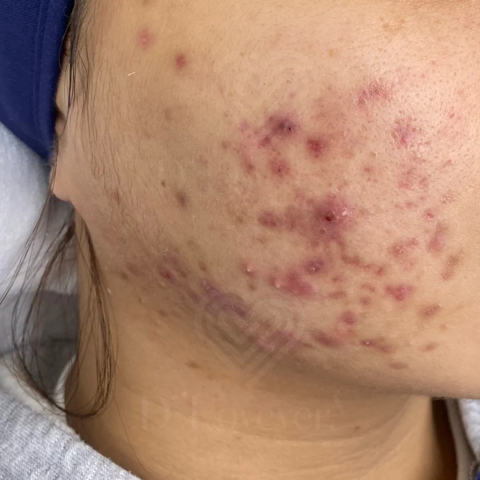 Right cheek and jawline inflamed acne cluster with papules, pustules, and hyperpigmentation