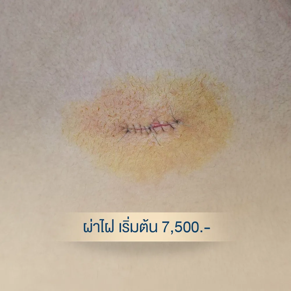 Close-up of mole excision stitches on antiseptic-stained skin
