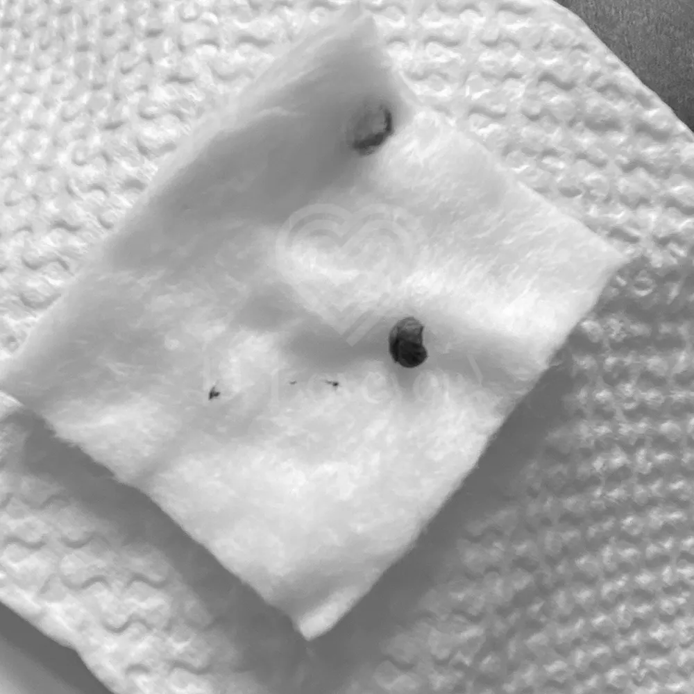 Close-up cotton pad with dark debris on embossed paper towel