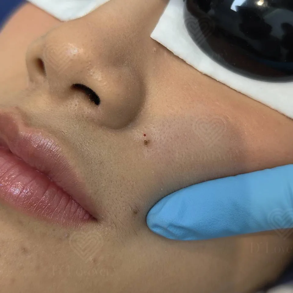 Close-up cheek mole removal: blue nitrile glove indicating brown moles