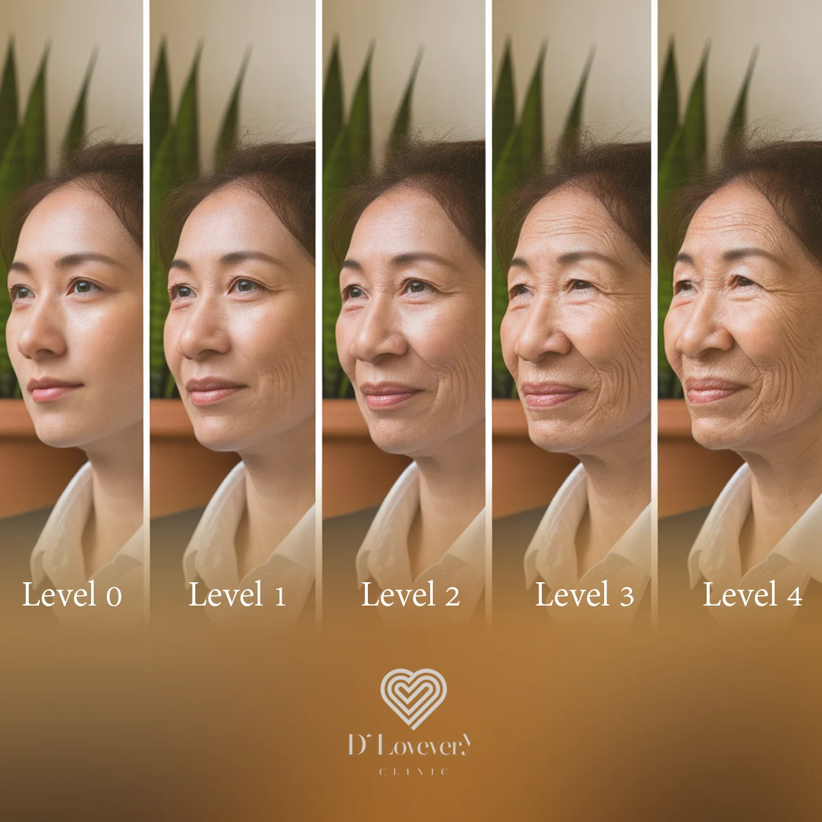 Five panels show nasolabial fold progression Levels 0-4 on the same woman.