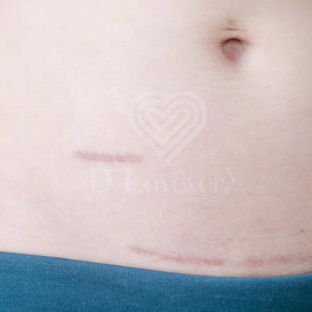 Healed C-section scar on lower abdomen above waistband