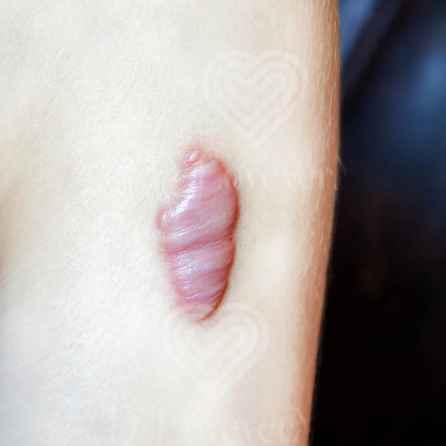 Close-up of raised pink keloid scar with horizontal ridges on normal skin
