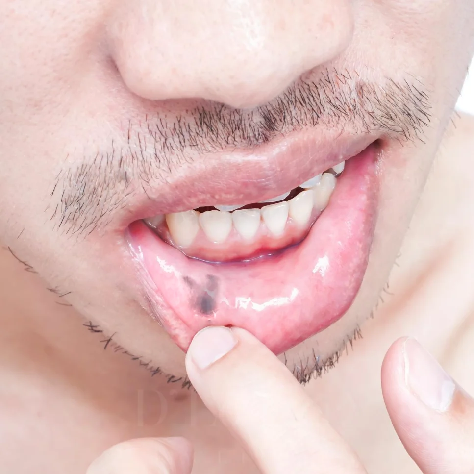 Close-up of inner lower lip mole on moist mucosa