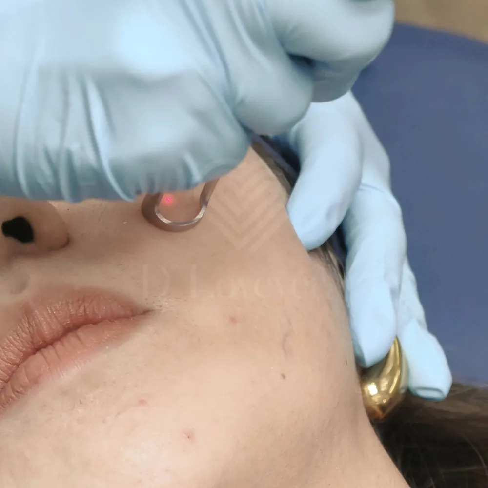Pico laser cheek treatment close-up: gloved hands, device tip, gold hoop earring