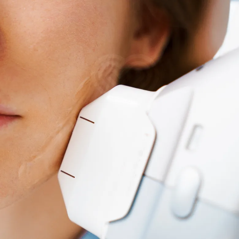 Ulthera ultrasound device on cheek and jawline with gel for noninvasive skin tightening