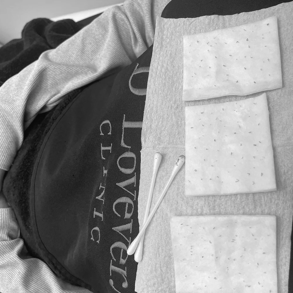 Acne extraction aftercare: speckled absorbent pads and used cotton swabs on underpad.