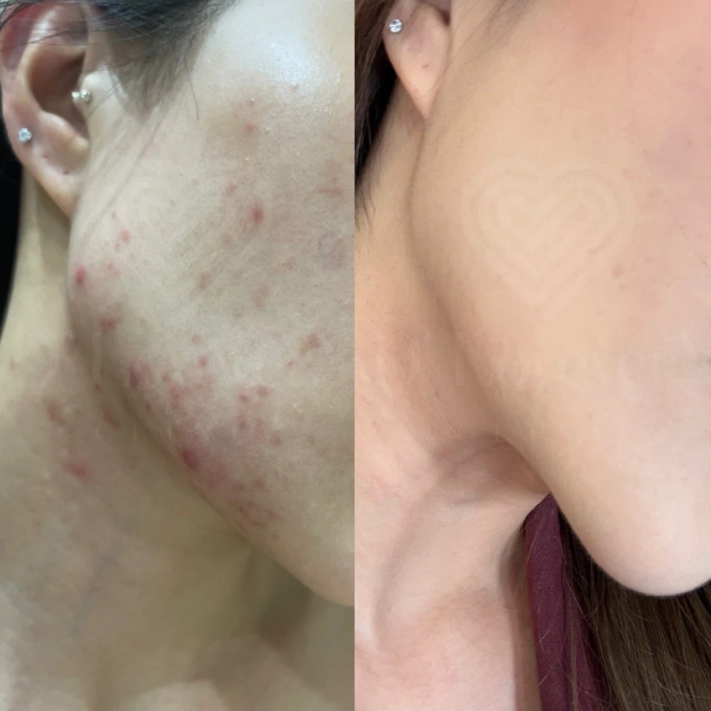 Jawline acne before-and-after treatment: inflamed bumps to clear, smooth skin