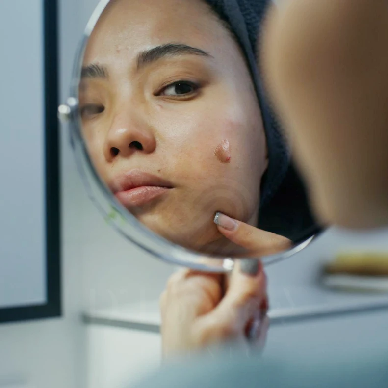 Person self-checking cystic acne in handheld mirror, close-up of cheek blemish