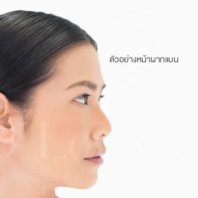 Side profile of woman with flat forehead, before filler treatment