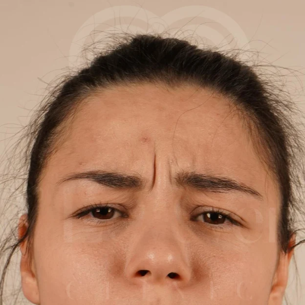 Close-up of woman with pronounced glabellar 11 frown lines, ideal Botox candidate