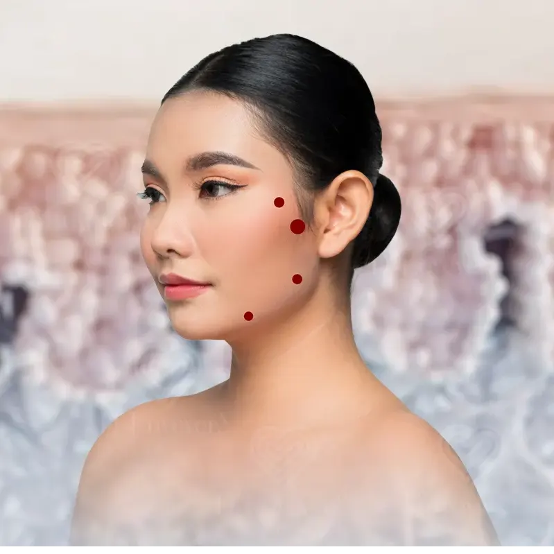 Profile of model showing four cheek and jaw cosmetic injection points.