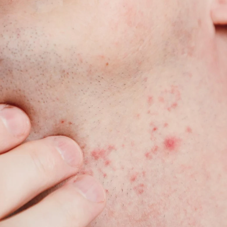 Jawline acne close-up showing inflamed papules and stubble, fingertips for scale