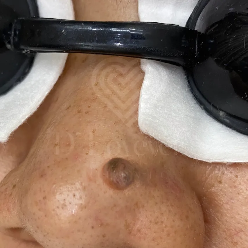 Large nasal bridge mole close-up for removal evaluation at clinic
