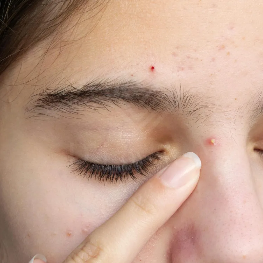 Close-up of nose pimple being gently touched during skincare